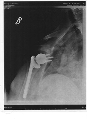 my R shoulder xray-after.jpg