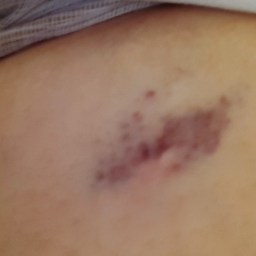 5-6-17 bruised ribs (2)